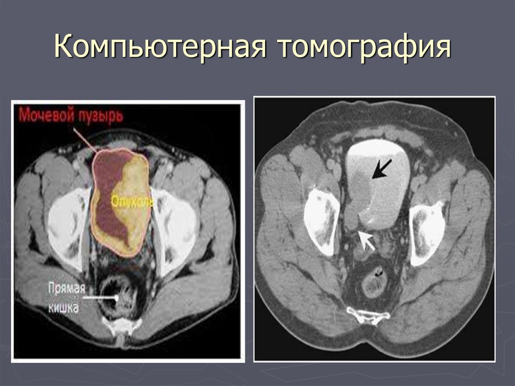 Мрт мочевого пузыря. Компьютерная томография мочевого пузыря. Кт и мрт мочевого пузыря. Кт почек и мочевого пузыря. Образование мочевого пузыря кт.