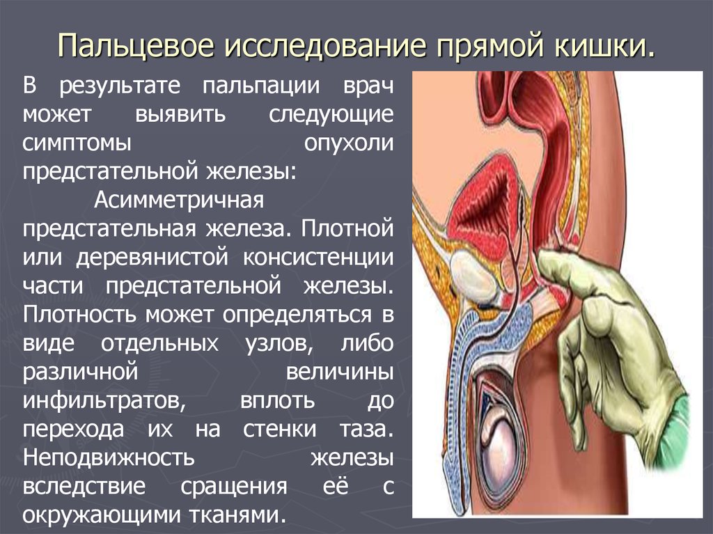 Исследование прямой кишки. Палцевое исследованиепрямой кишки. Пальпаторный осмотр прямой кишки. Пальцевое исследование прямой Кишк. Пальцевое ректальное исследование прямой кишки.