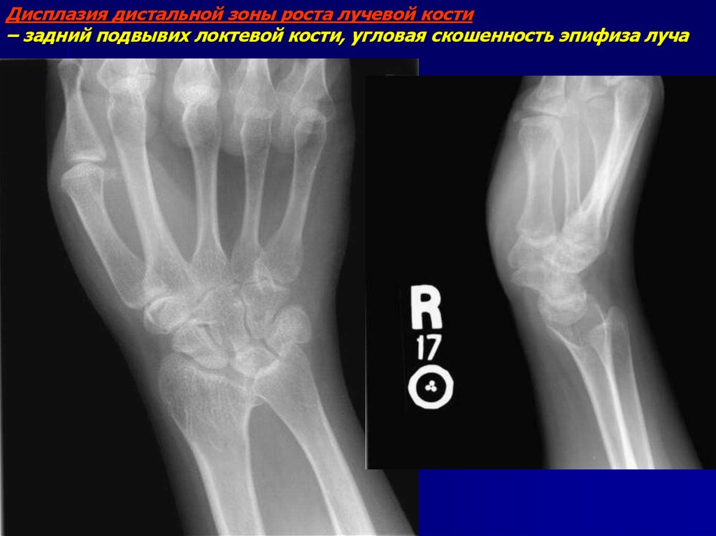 Зона роста кости. Подвывих лучевой кости. Зона роста лучевой кости. Зона роста локтевой кости. Дистальный эпифиз лучевой кости.