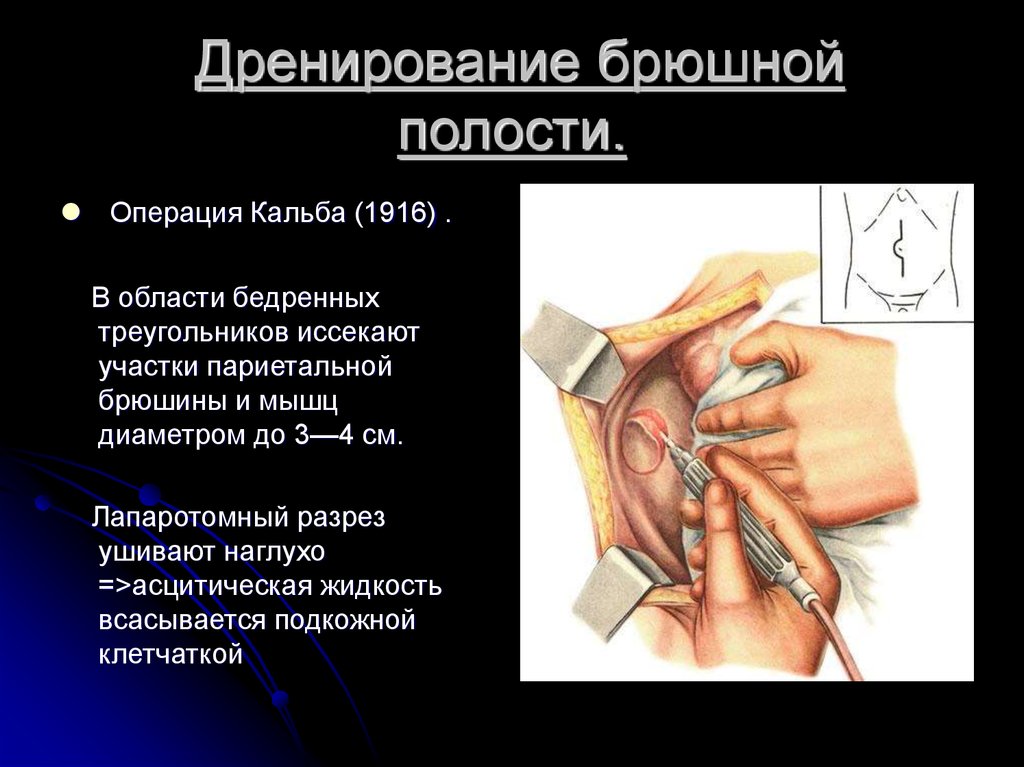 Дренирование брюшной полости.