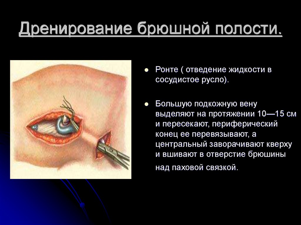 Дренирование брюшной полости.