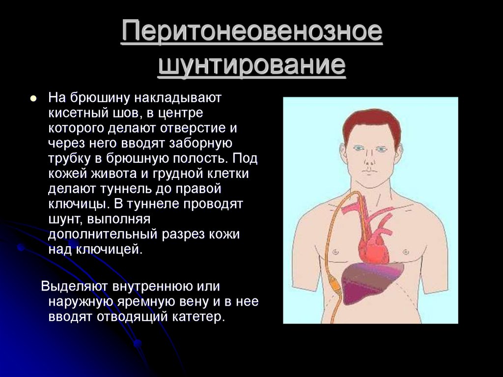 Перитонеовенозное шунтирование