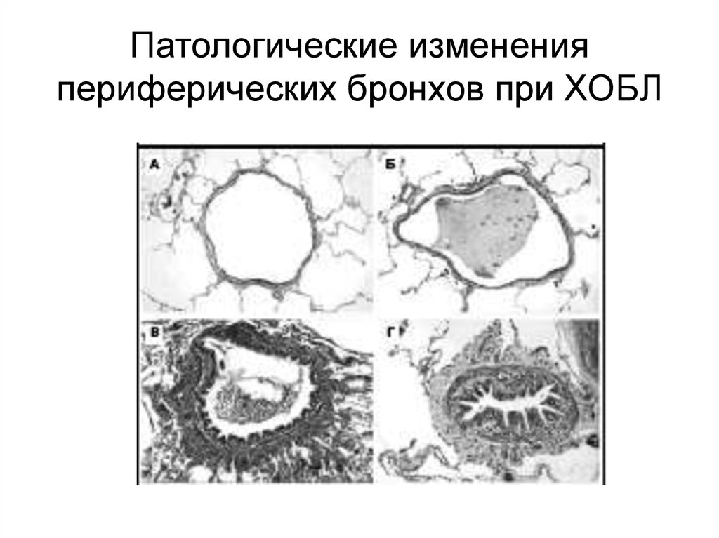 Патологические изменения. Основные патоморфологические изменения при ХОБЛ. Патологические изменения периферических бронхов при ХОБЛ. Патоморфологические изменения периферических бронхов при ХОБЛ. Патологические изменения при хронической легочной недостаточности.