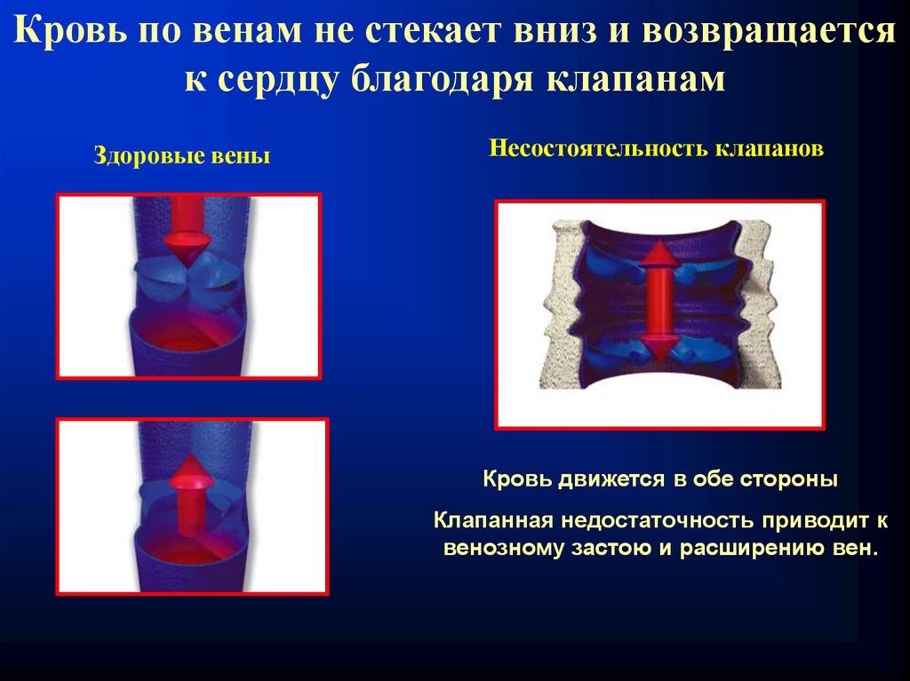 Недостаточность клапанов нижних конечностей