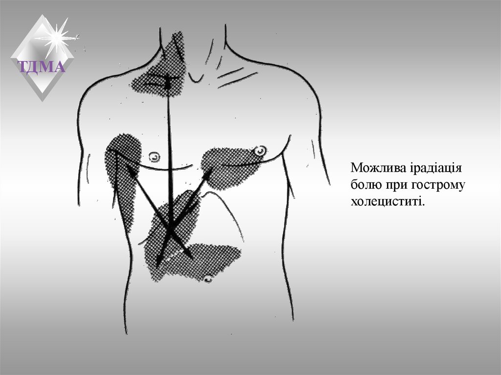 Боли при холецистите. Острый холецистит иррадиация болей. Иррадиация болей при остром холецистите. Иррадиация боли при холецистите. Хронический холецистит иррадиация болей.