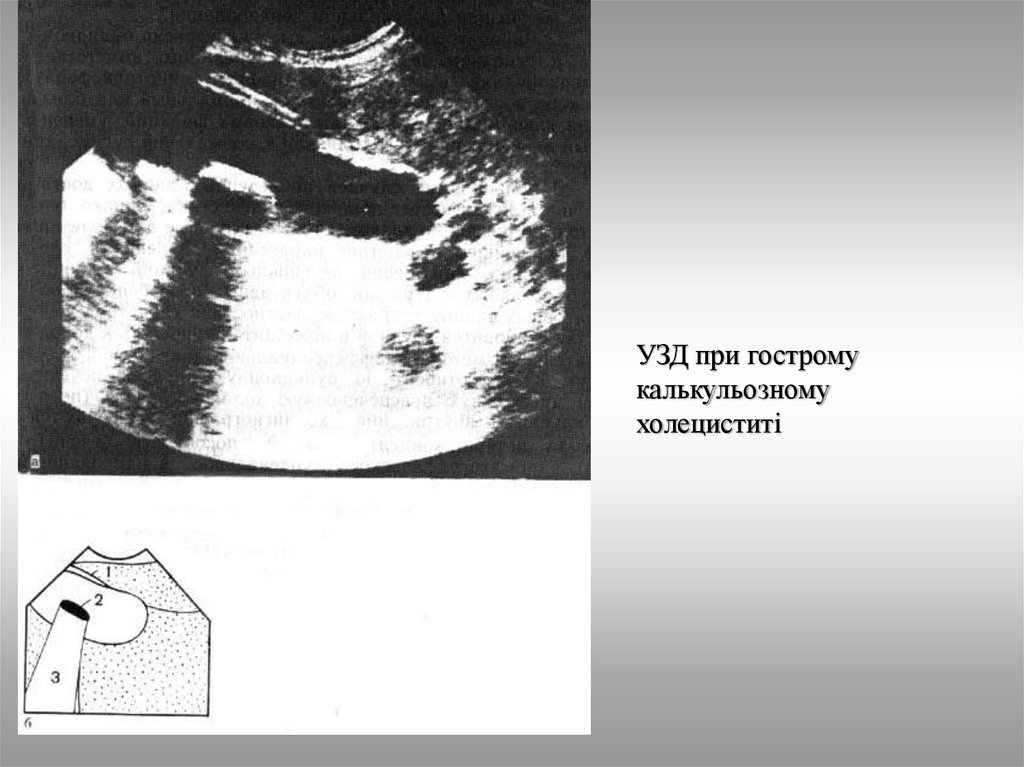 Эхопризнаки холецистита. Острый калькулезный холецистит УЗИ. Калькулезный холецистит УЗИ. Курлезнй холецистит УЗИ.