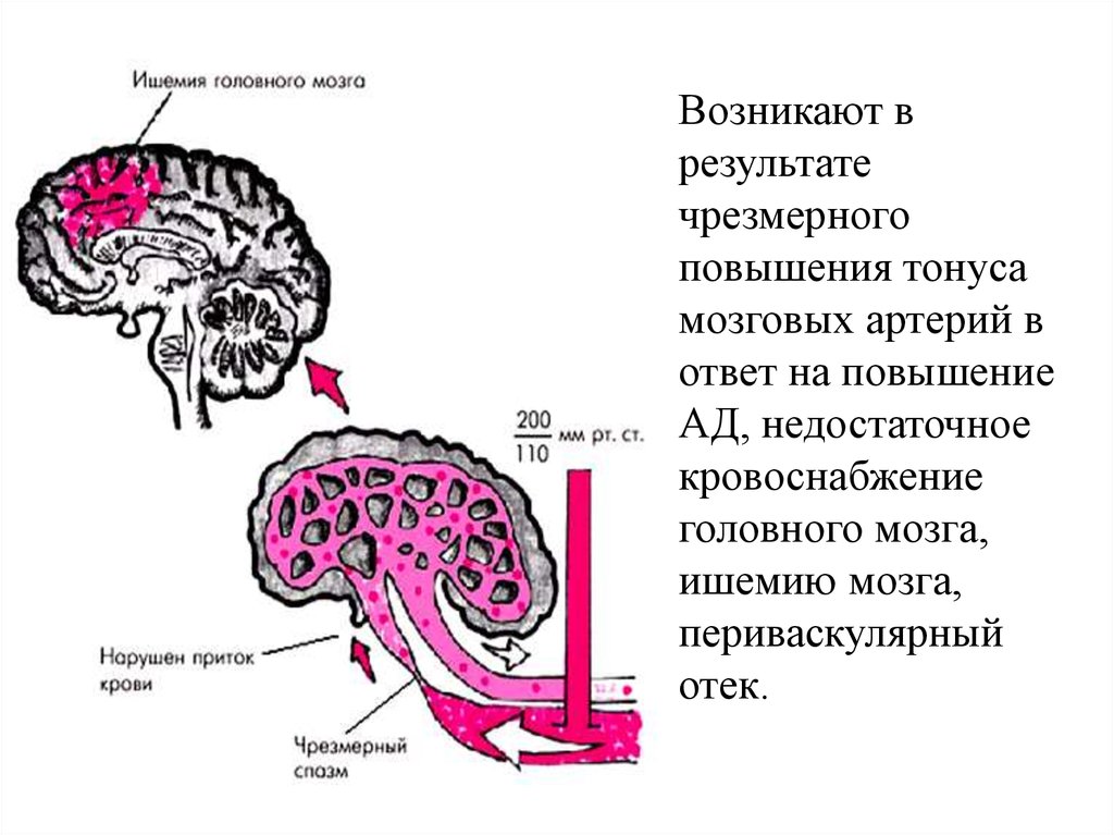 Недостаточно головного мозга. Тонус головного мозга. Недостаточное кровоснабжение мозга. Мозговая форма гипертонической болезни.