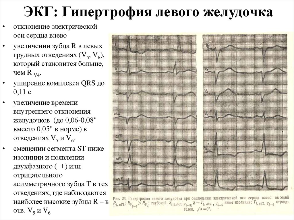 Перегрузка на экг что это. ЭКГ- критерии гипертрофии лж. ЭКГ при гипертрофии миокарда правого желудочка. Гипертрофия левых отделов сердца на ЭКГ. Гипертрофия левого желудочка на ЭКГ.