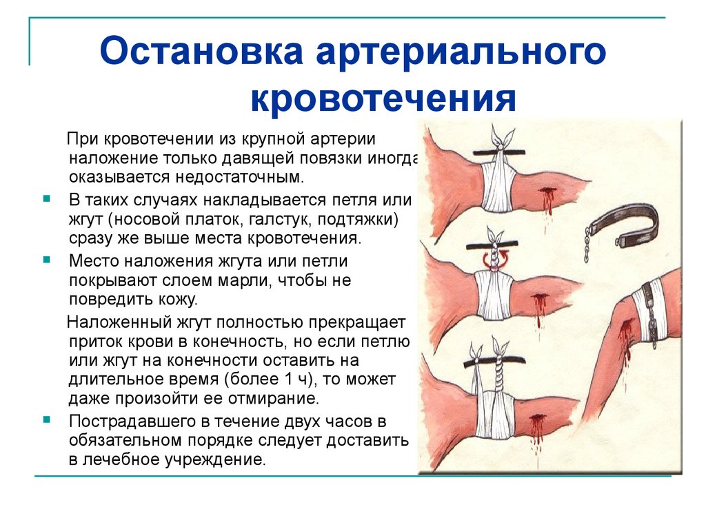 При кровотечении из артерии. Методы остановки артериального кровотечения алгоритм. Остановка артериального кровотечения алгоритм. Способы временной остановки артериального кровотечения. Временной остановки артериального кровотечения из крупной артерии.