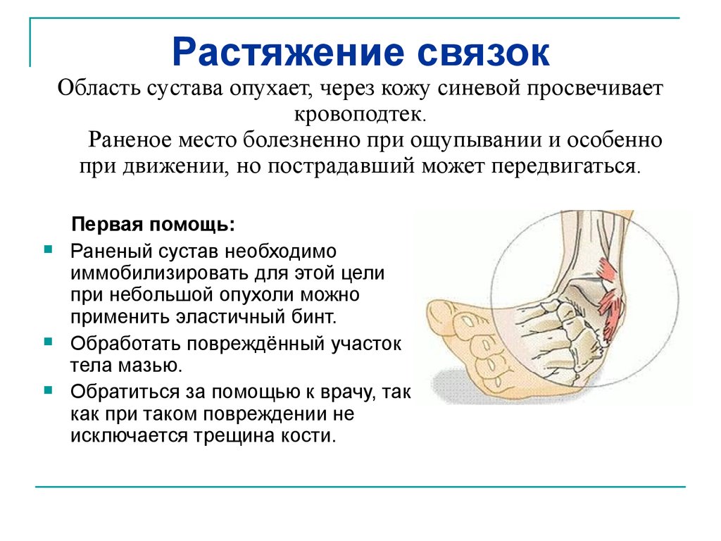 Растяжение и разрыв связок первая помощь