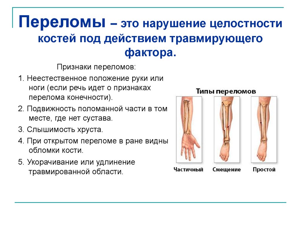 Типы закрытых переломов. Характеристика переломов костей. Симптоматика перелома кости. Переломы костей презентация.