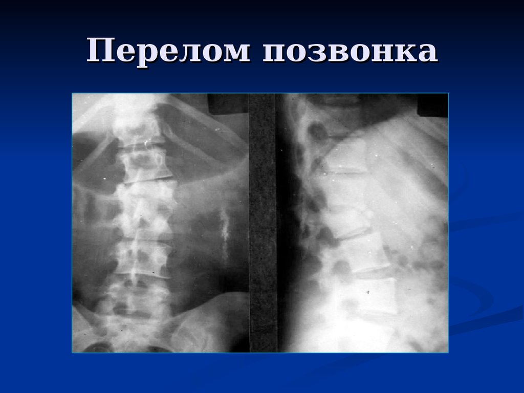 Перелом поясницы. Компрессионный перелом позвоночника рентгенограмма. Rjvghtccbjyysq gthtkjv htnuty. Перелом 12 грудного позвонка рентген. Импрессионный перелом позвонка.