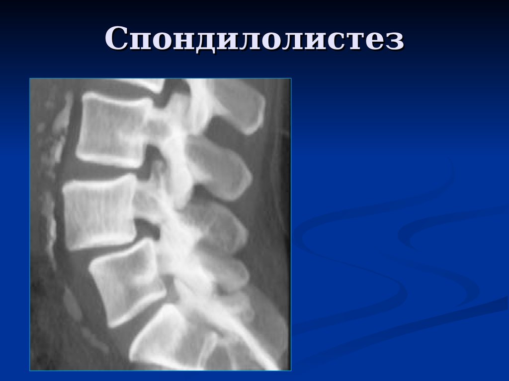 Спондилолистез. Спондилолистез l4 позвонка рентген. Спондилолистез – смещение позвонков. Спондилолистез l4 позвонка что это такое. Ретролистез l5 позвонка рентген.