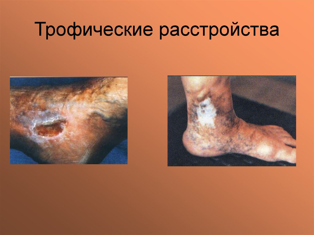 Трофические расстройства