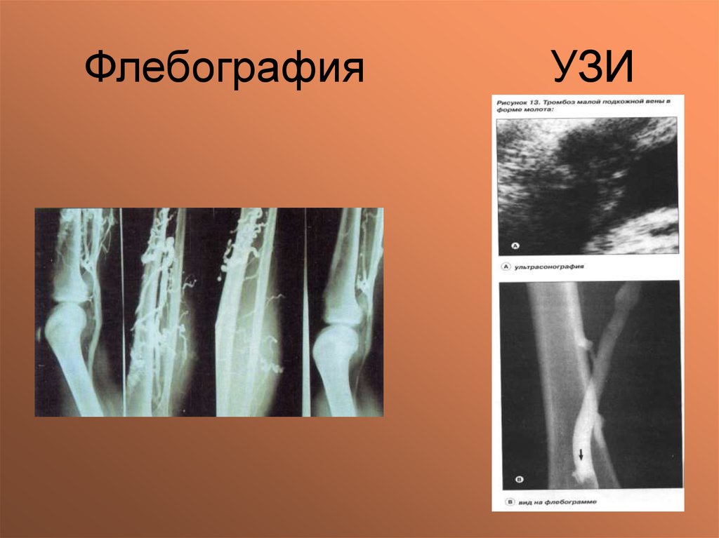 Флебография вен нижних. Ретроградная бедренная флебография. Рентгеноконтрастная флебография. Флебография нижних конечностей. Функционально-динамическая флебография).