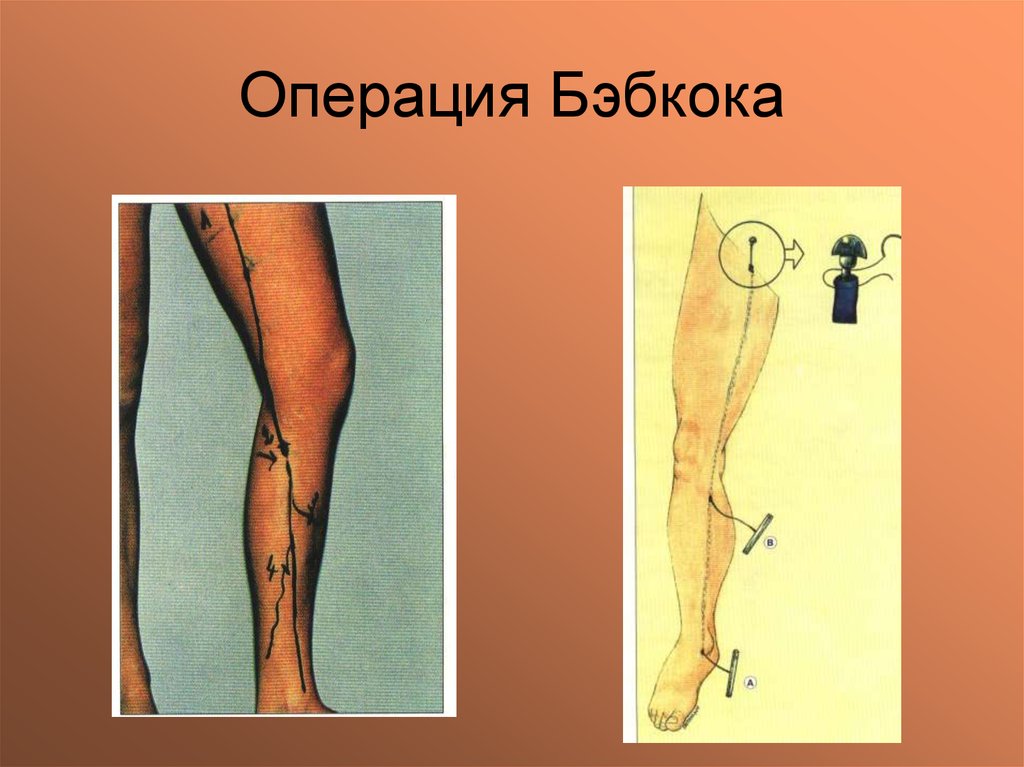 Операция Бэбкока