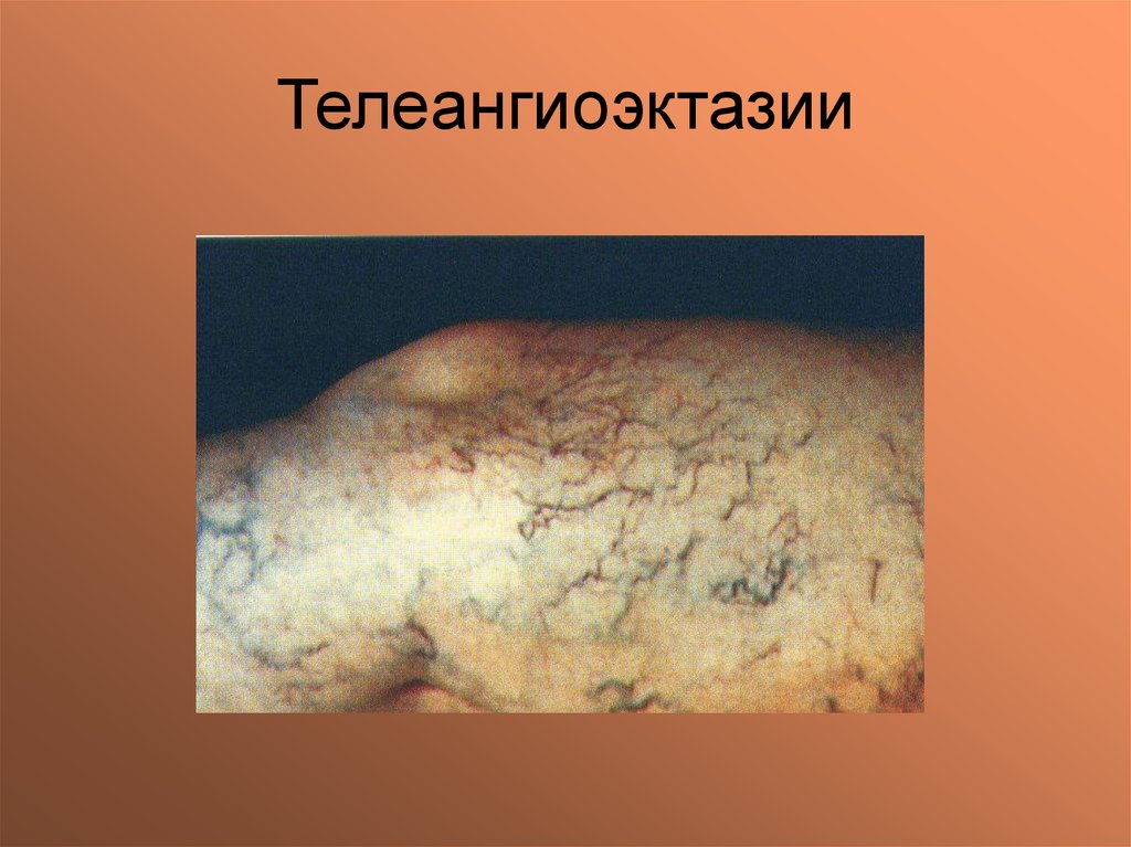 Варикозная болезнь - презентация онлайн