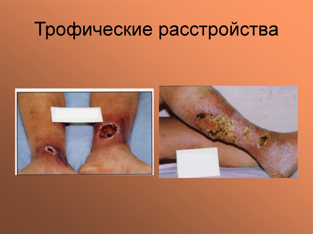 Трофические расстройства