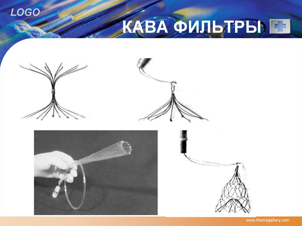 Установка кава фильтра. Кава фильтр ALN. Имплантация кава-фильтра. Кава фильтр елочка. Кава-фильтр ангиография.