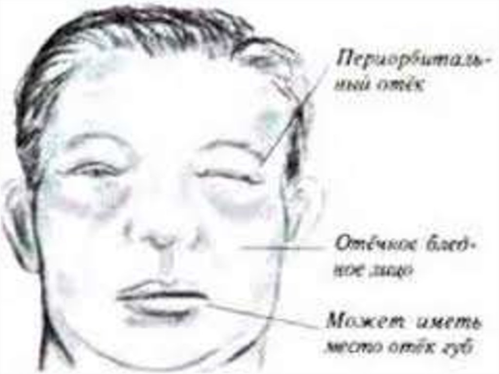 Синдром неживого лица. Отеки при остром гломерулонефрите с нефротическим синдромом:. Отечный синдром при нефротическом синдроме.