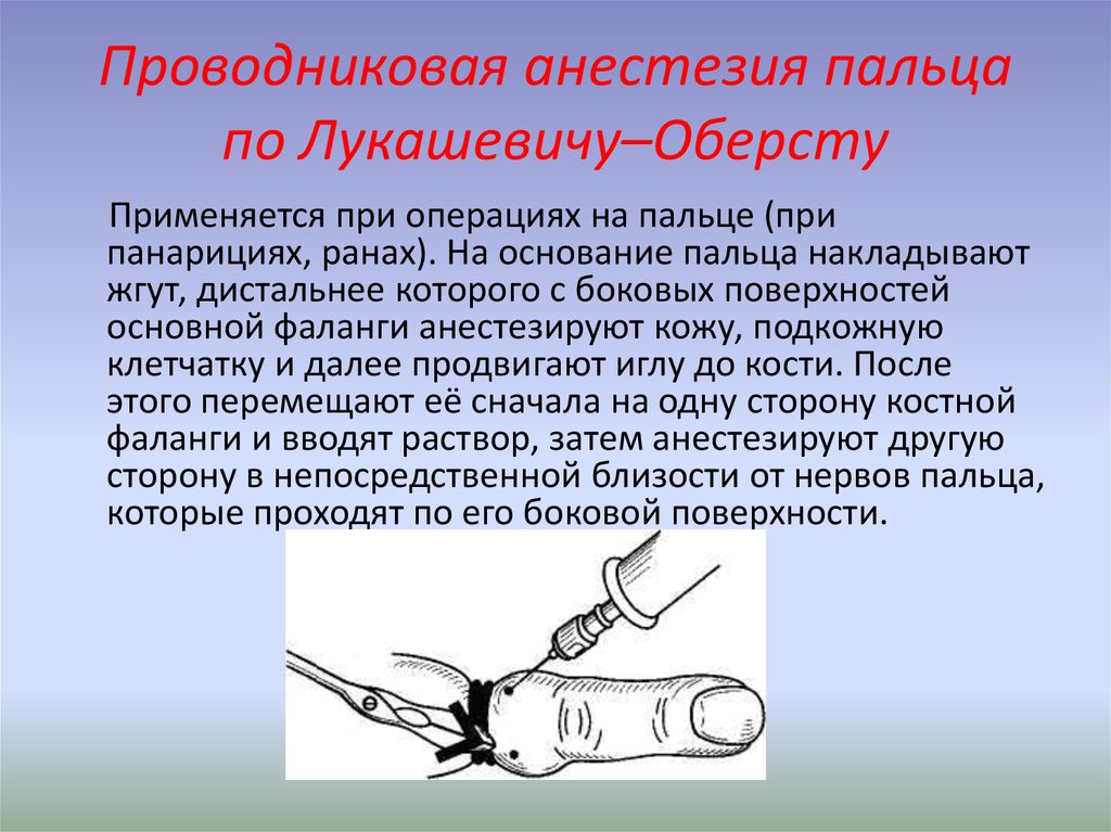 Проводниковая анестезия пальца по Лукашевичу–Оберсту