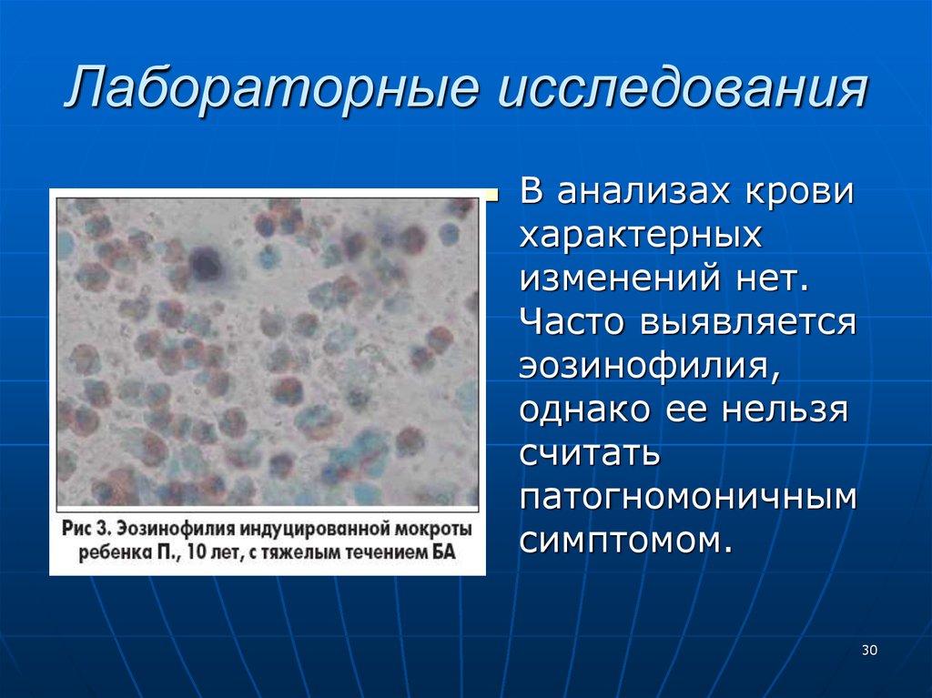 Эозинофилия при астме. Эозинофилия в мокроте характерна. Эозинофилия характерна для. Эозинофилия симптомы. Спирали Куршмана при бронхиальной астме.