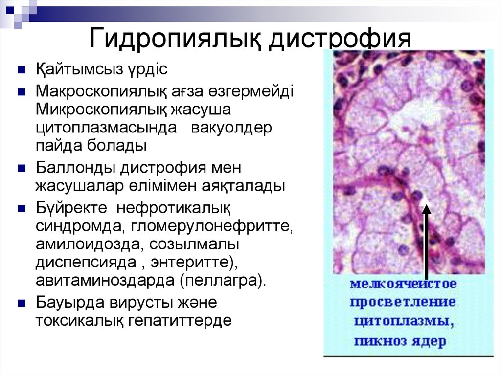 Процесс сопровождающийся накоплением в цитоплазме гепатоцитов. Паренхиматозная гидропическая дистрофия. Гидропическая дистрофия эпителия канальцев почки. Гидропическая дистрофия патанатомия. Гидропическая дистрофия гепатоцитов.