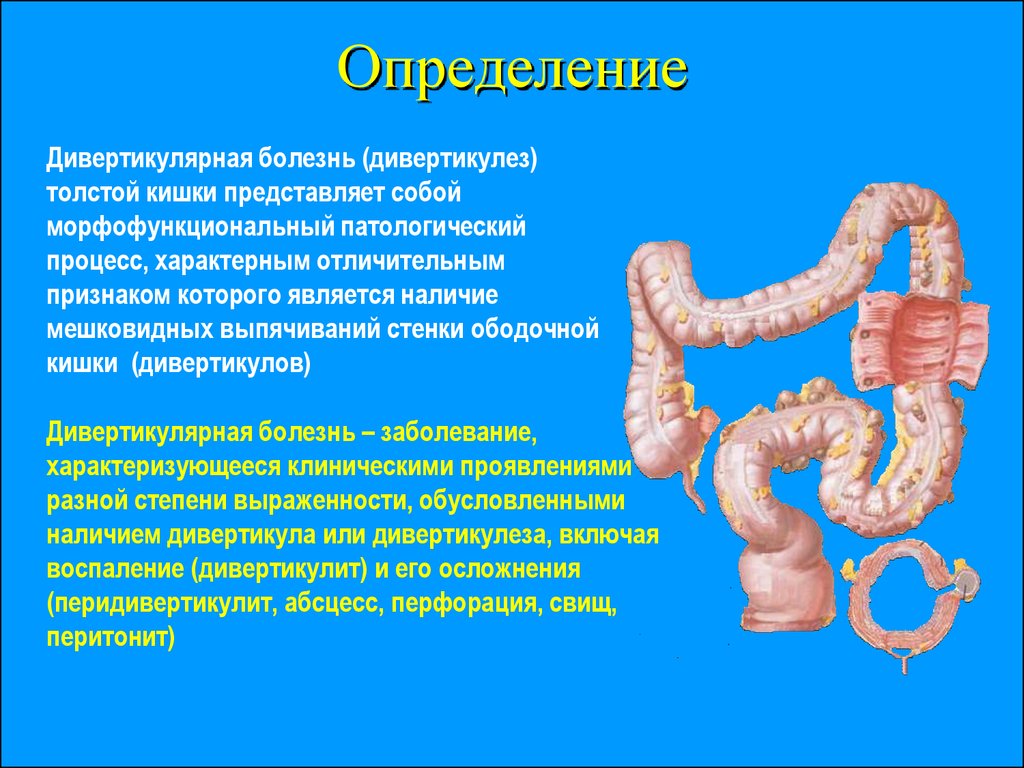 Кишки признаки. Сигмовидная Толстого кишечника. Сигмовидная кишка анатомия. Что такое дивертикулит Толстого кишечника. Дивертикулы сигмовидной кишки.