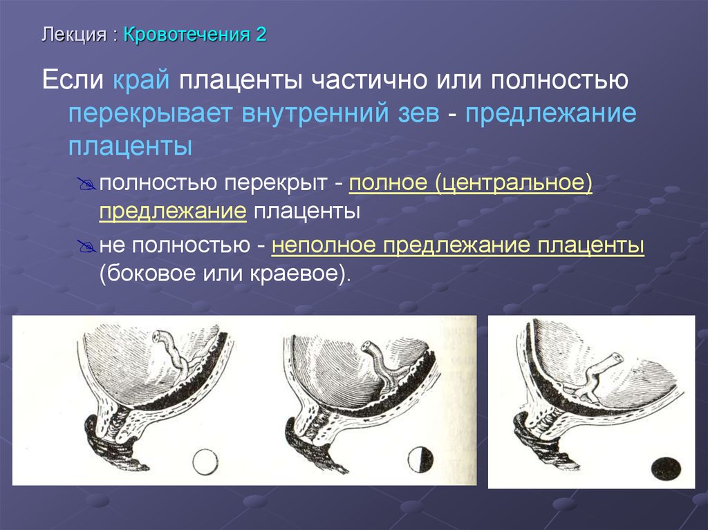 Патологическое прикрепление плаценты предлежание и врастание плаценты. Предлежание плаценты. Формы предлежания плаценты. Предлежание плаценты классификация. Предлежание плаценты влагалищное исследование.