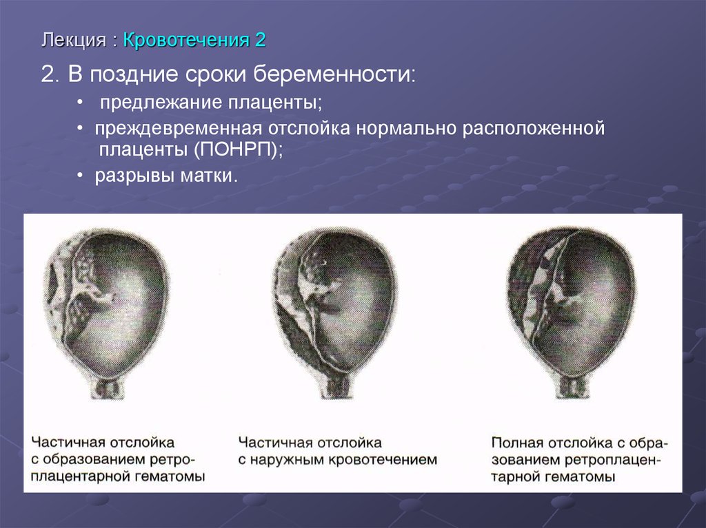 Отслойка плаценты при беременности. Предлежание и отслойка плаценты. Предлежание плаценты и преждевременная отслойка плаценты. Кровотечения при нормально расположенной плаценты. Предлежание плаценты и отслойка нормально расположенной плаценты.