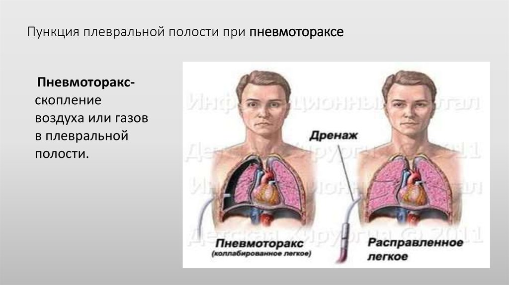 Пункция при пневмотораксе