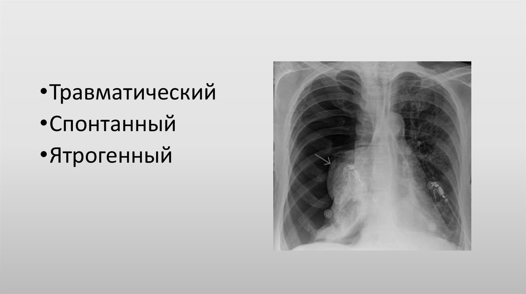 Пневмоторакс лучевая диагностика презентация