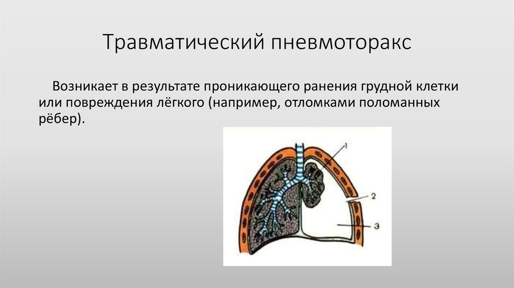 Спонтанный пневмоторакс карта вызова смп