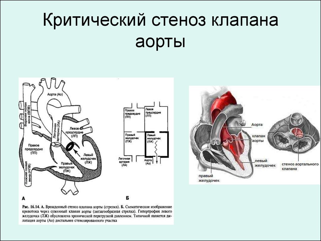 Аортальный стеноз что это такое. ВПС стеноз аортального клапана. Клапанный, надклапанный и подклапанный стеноз аорты. Критический стеноз аортального клапана.