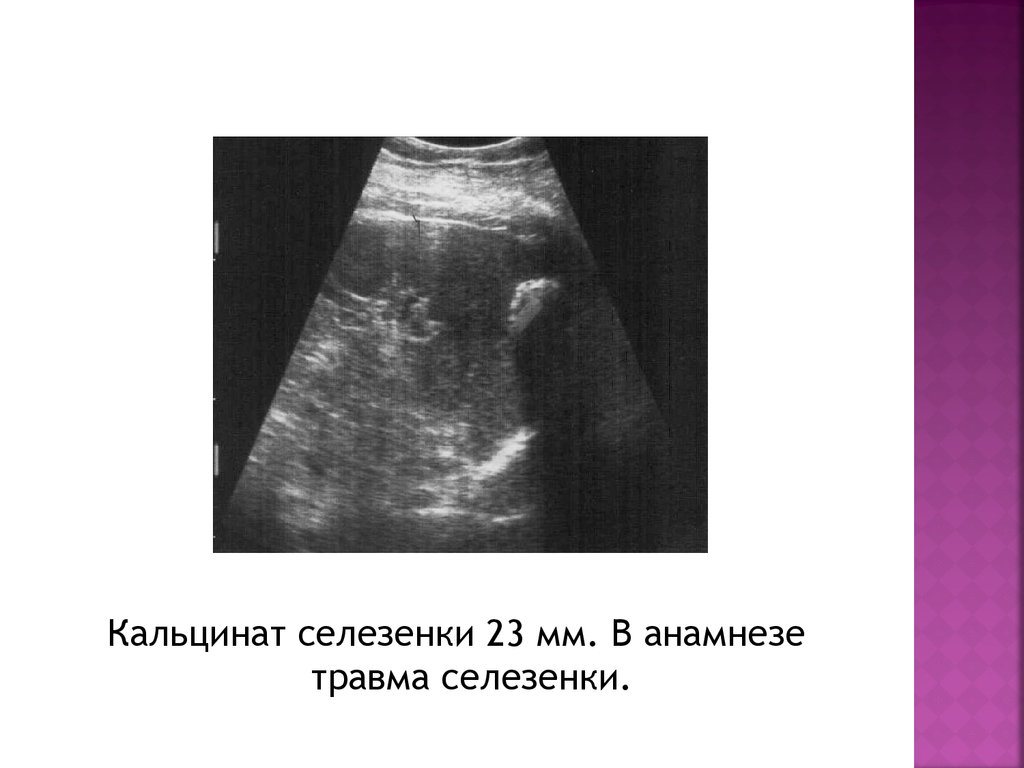 Кальцинат доли печени. Кальцинаты в селезенке на УЗИ. Гематома селезенки на УЗИ. Кальцинат в селезенке на кт. Кальциноз селезенки на УЗИ.