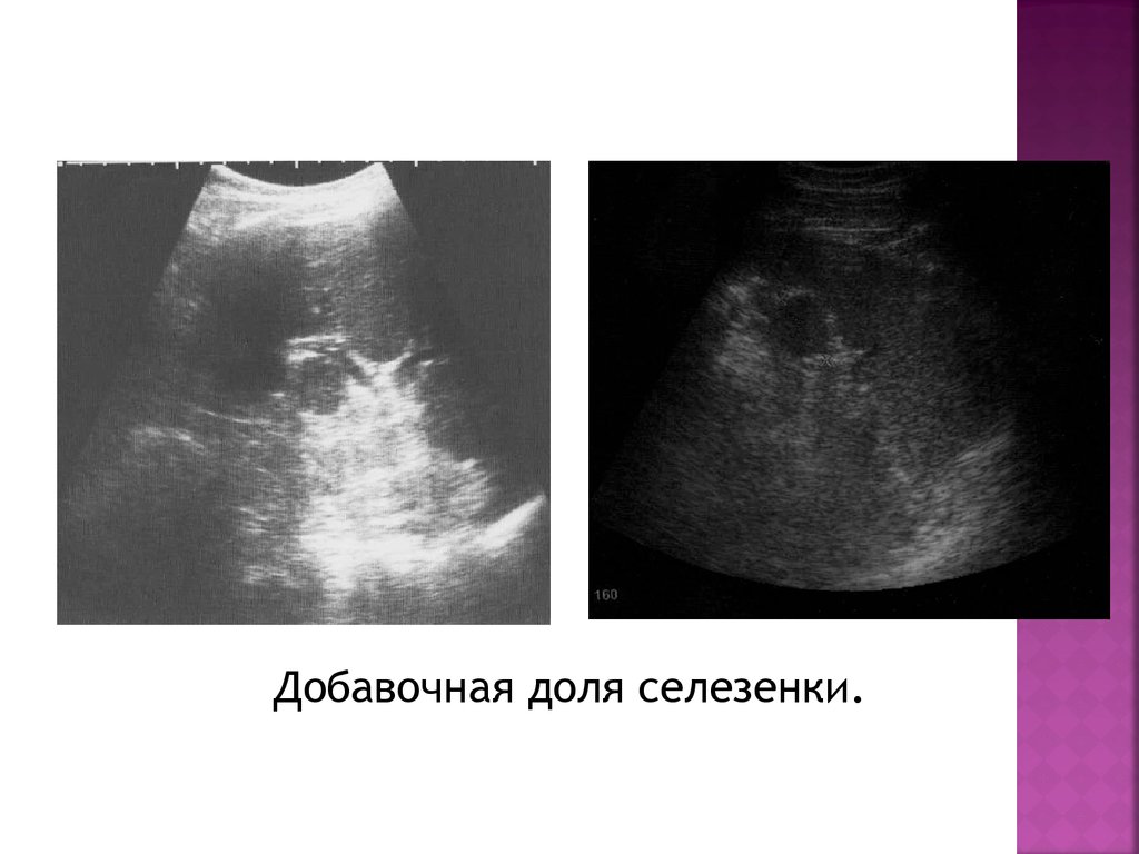 Долька селезенки. Добавочная долька селезенки на УЗИ. Добавочная долька селезенки на кт. Дополнительная долька селезенки что это такое у взрослого.