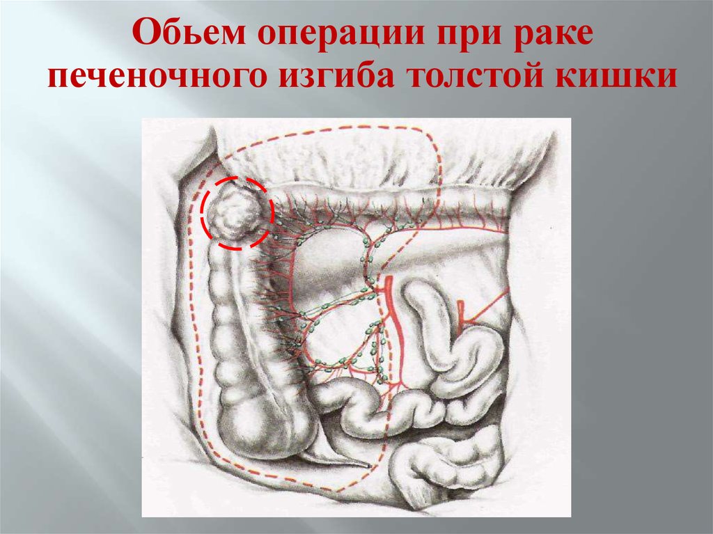 Изгиб кишечника. Печеночный угол Толстого кишечника. Печеночная кривизна ободочной кишки. Печеночный угол ободочной кишки. Печеночный изгиб ободочной кишки.