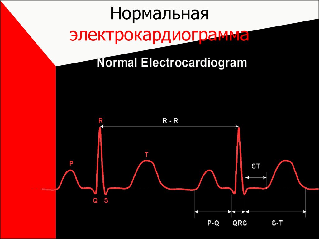 Нормальная электрокардиограмма