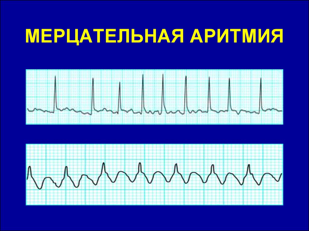 Острые нарушения сердечного ритма. Острые нарушения ритма.