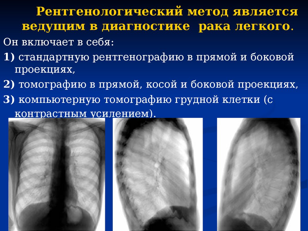 Методы легких. Рентгенологический метод. Рентгенологические методы диагностики. Рентгенологический метод является ведущим. Рентгенологический диагноз.