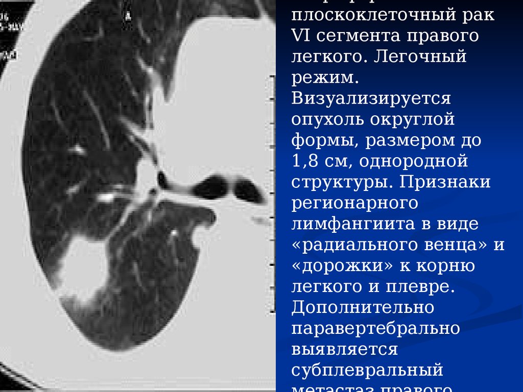 Рак центрального правого. Переферический очаг правого легкого. Периферические опухоли легких. Периферическое новообразование в легких.
