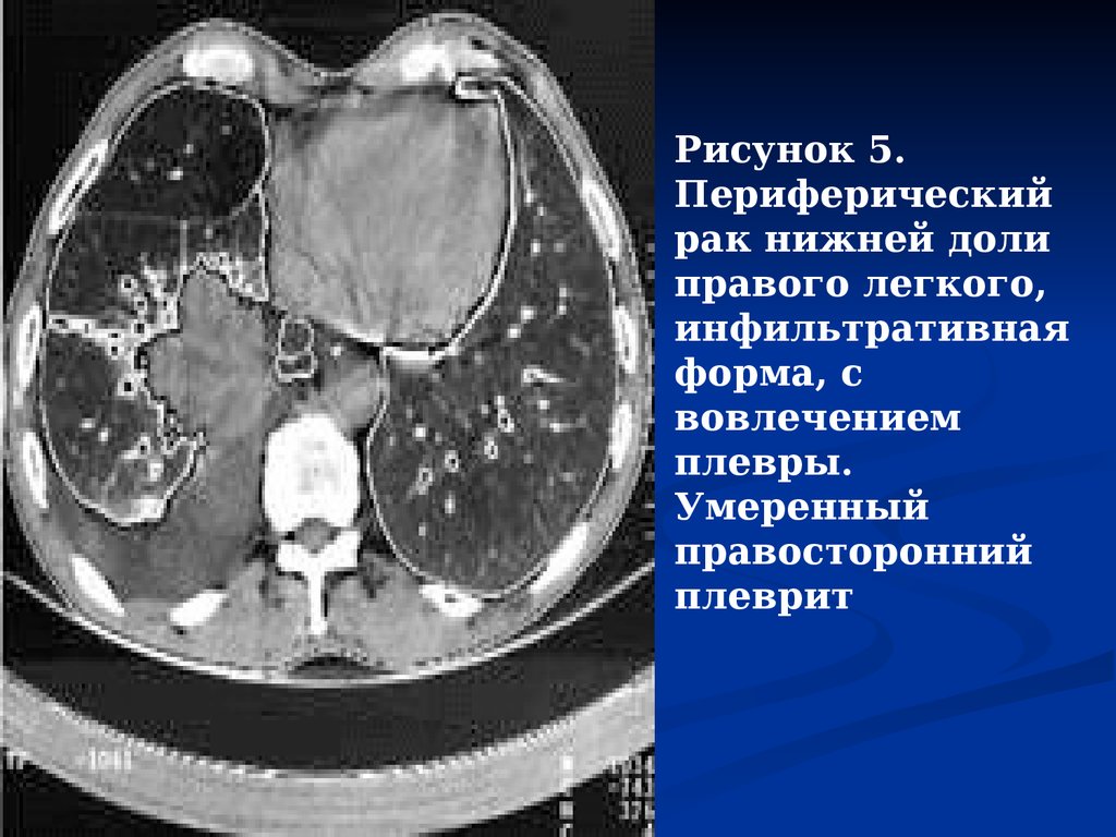 Полость в легком. Хронический абсцесс лёгкого кт. Синдром полости в легком патогенез. Синдром полости кт легких.