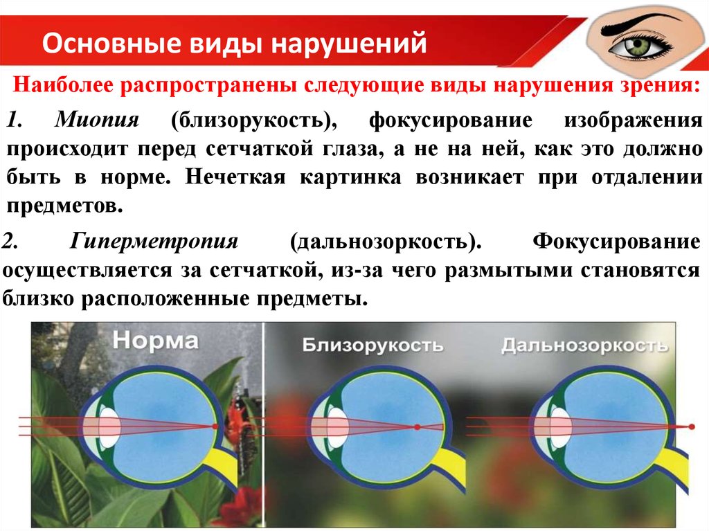 Нарушения функций зрения. Нарушение зрения. Нарушение зрения близорукость. Типы нарушения зрения. Нарушение зрения миопия.