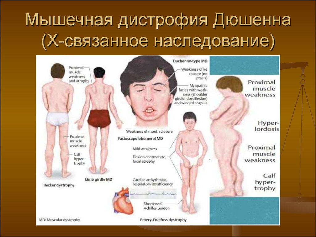 Мышечные заболевания детей. Синдром мышечной дистрофии Дюшенна. Миодистрофия Дюшенна болезнь. Прогрессирующая мышечная дистрофия Дюшенна симптомы. Дистрофия Дюшенна Тип наследования.