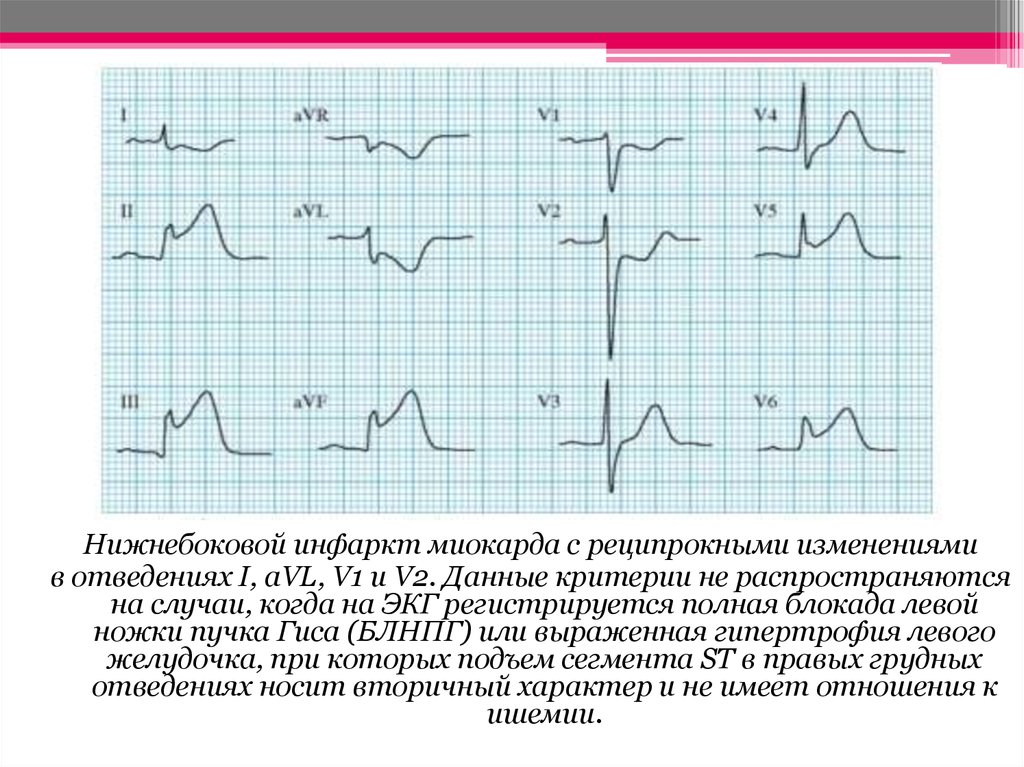 Отведение v1 на экг. ЭКГ при БЛНПГ И инфаркте миокарда. ЭКГ при Нижнем инфаркте миокарда левого желудочка. Подъем сегмента St i II,v2-v6avf. Инфаркт миокарда ЭКГ реципрокные изменения.