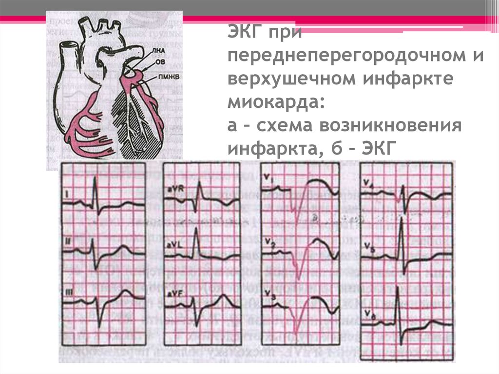 Изменение миокарда перегородочной области. Переднеперегородочный инфаркт на ЭКГ. Острый передне перегородочный инфаркт ЭКГ. Переднеперегородочный инфаркт миокарда на ЭКГ. ЭКГ при передне-перегородочном инфаркте миокарда.