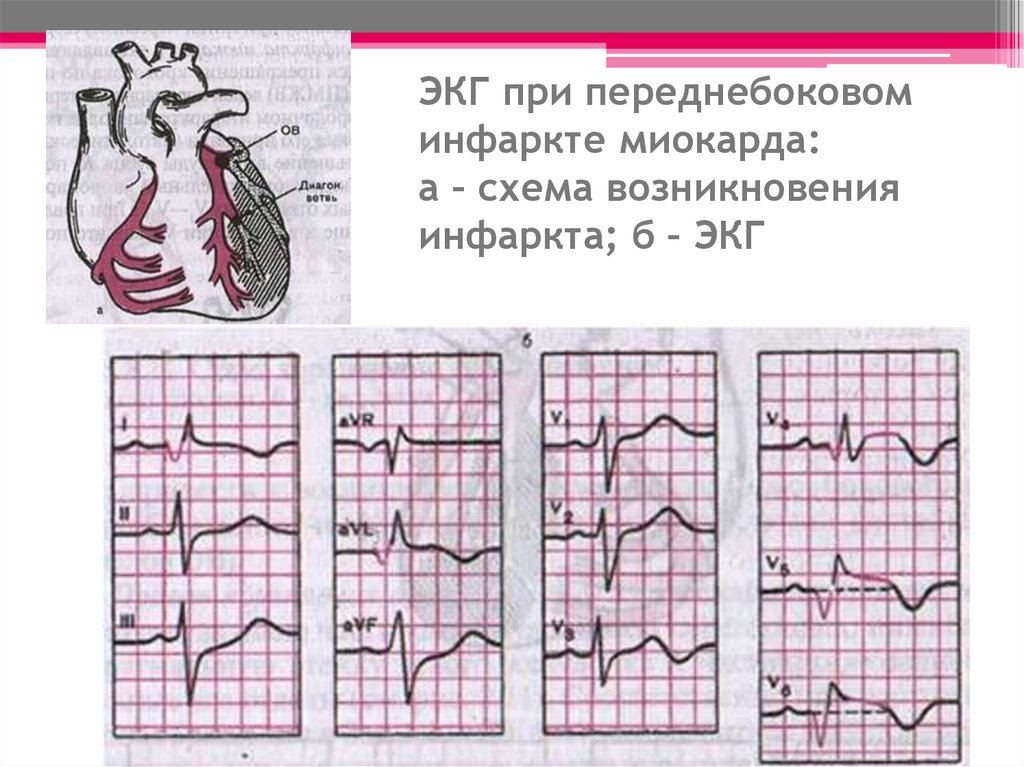 Изменение боковой стенки левого желудочка. ЭКГ при переднебоковом инфаркте миокарда. Передней боковой инфаркт ЭКГ. Инфаркт переднебоковой стенки ЭКГ. ЭКГ передне перегородочный инфаркт.