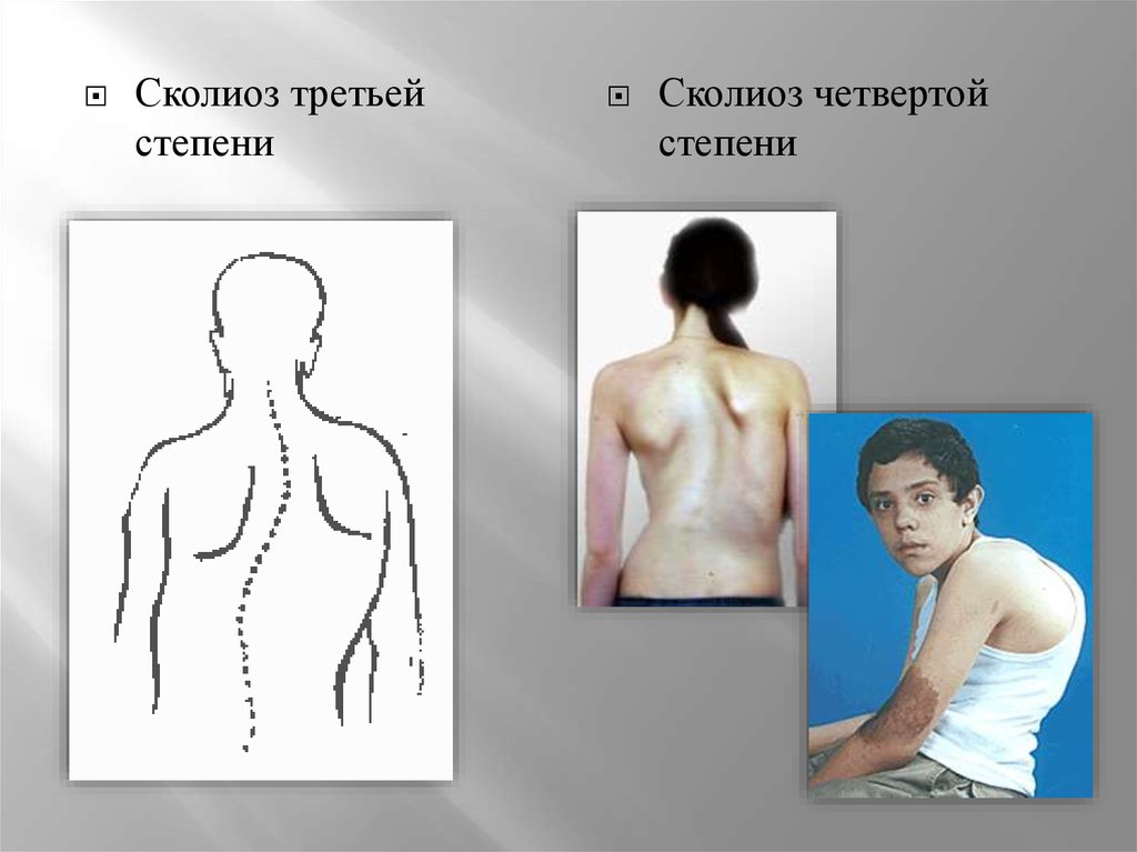 Сколиоз степени. Искривление позвоночника 4 степени. Искривление позвоночника 3 степени.