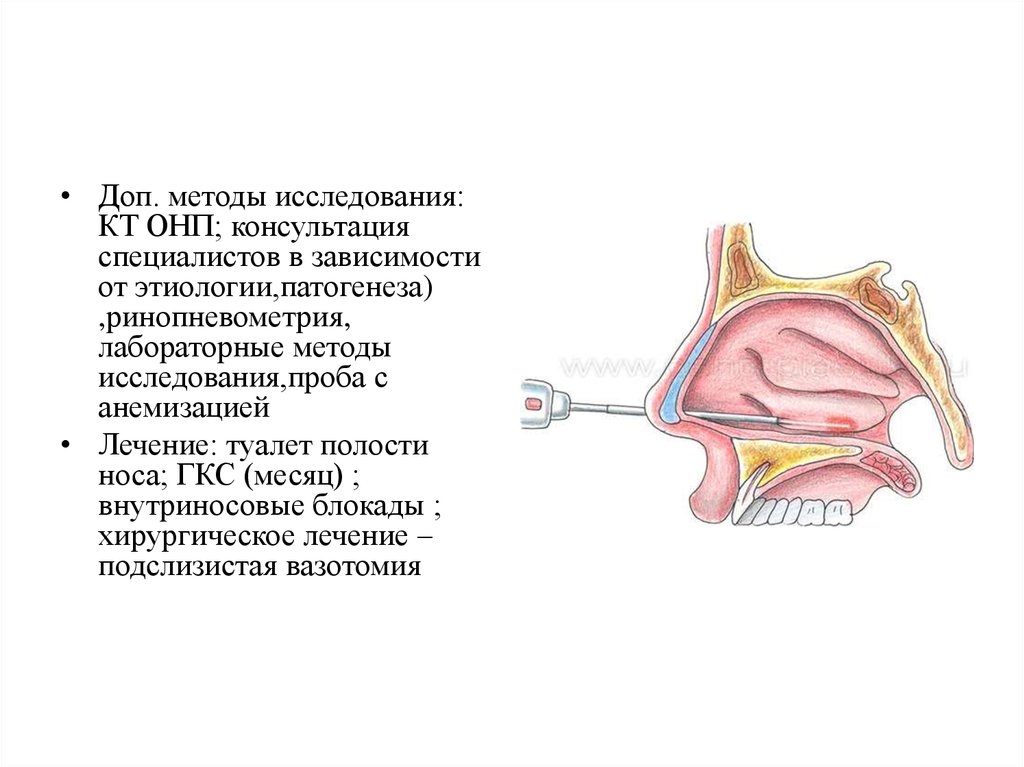Нижняя подслизистая вазотомия. Внутриносовая блокада схема. Блокада носовых раковин Дипроспан. Блокада нижних носовых раковин.