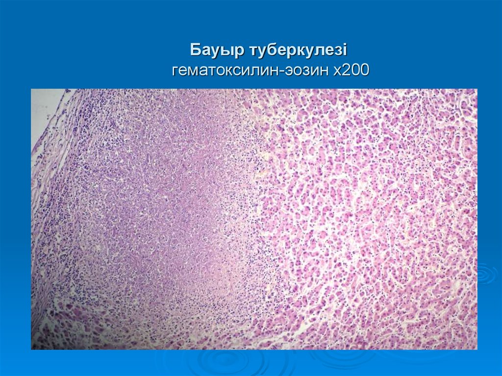 Бауыр туберкулезі гематоксилин-эозин х200